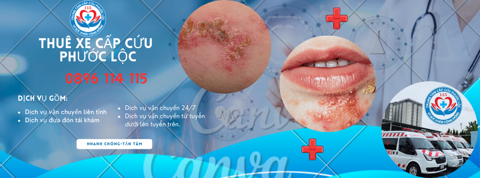 vận chuyển bệnh nhân bị viêm loét ngoài da không thể tự di chuyển,bằng xe cấp cứu Phước Lộc