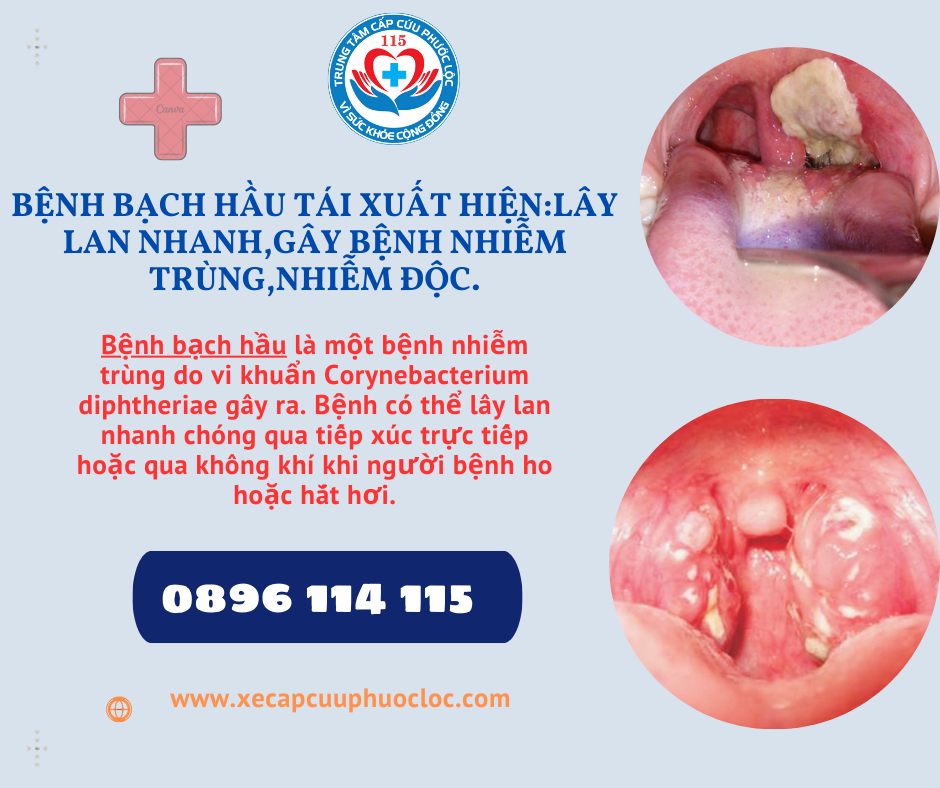 Bệnh bạch hầu là một bệnh nhiễm trùng do vi khuẩn Corynebacterium diphtheriae gây ra